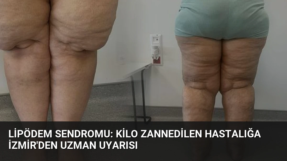 Lipödem Sendromu: Kilo Zannedilen Hastalığa İzmir’den Uzman Uyarısı
