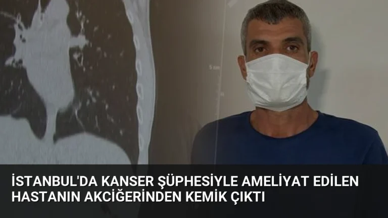 İstanbul’da Kanser Şüphesiyle Ameliyat Edilen Hastanın Akciğerinden Kemik Çıktı