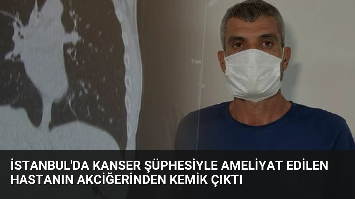 İstanbul’da Kanser Şüphesiyle Ameliyat Edilen Hastanın Akciğerinden Kemik Çıktı