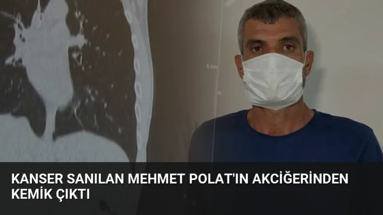 Kanser Sanılan Mehmet Polat’ın Akciğerinden Kemik Çıktı