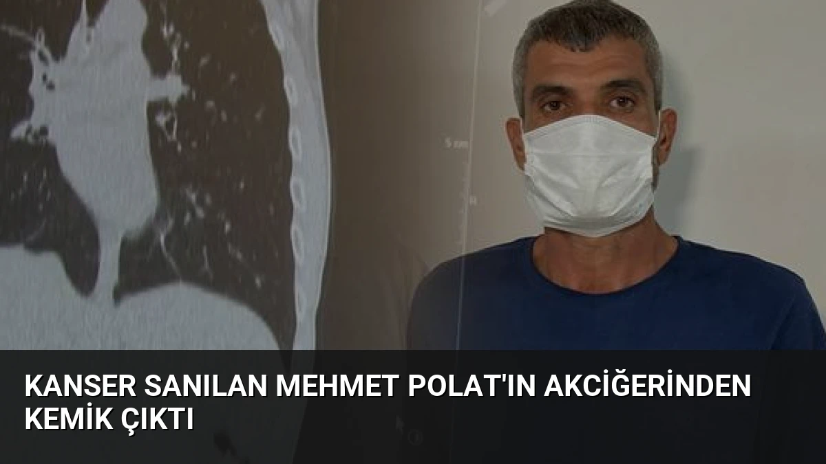 Kanser Sanılan Mehmet Polat’ın Akciğerinden Kemik Çıktı