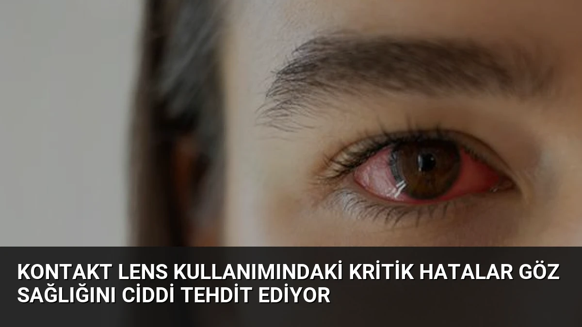 Kontakt Lens Kullanımındaki Kritik Hatalar Göz Sağlığını Ciddi Tehdit Ediyor