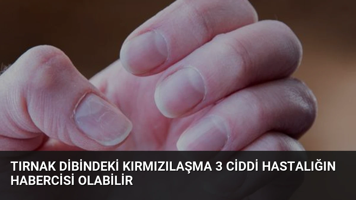 Tırnak Dibindeki Kırmızılaşma 3 Ciddi Hastalığın Habercisi Olabilir