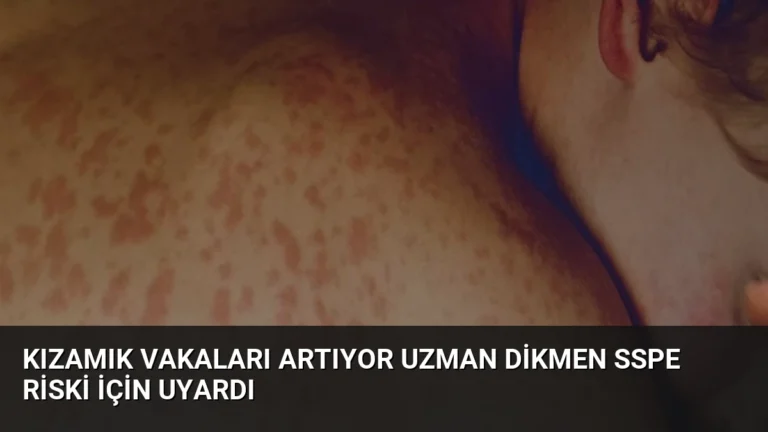 Kızamık Vakaları Artıyor Uzman Dikmen SSPE Riski İçin Uyardı