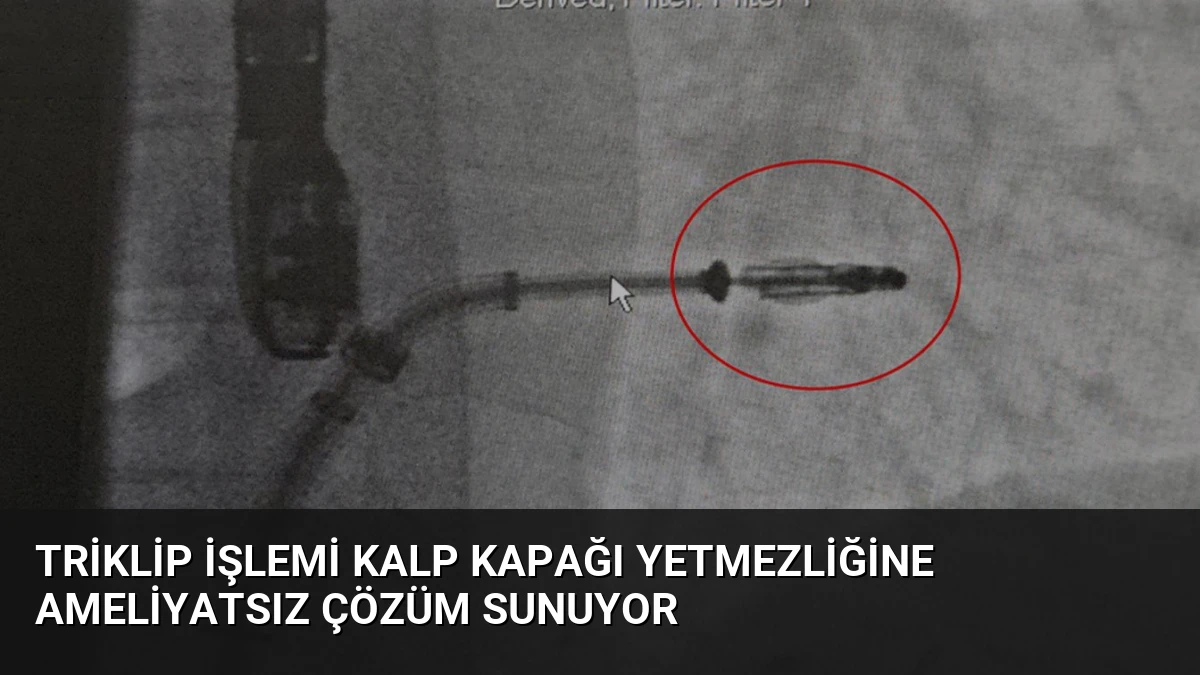 Triklip İşlemi Kalp Kapağı Yetmezliğine Ameliyatsız Çözüm Sunuyor