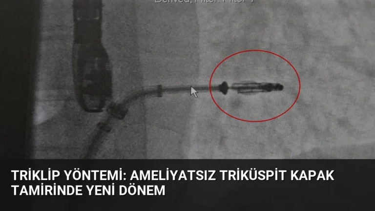Triklip Yöntemi: Ameliyatsız Triküspit Kapak Tamirinde Yeni Dönem