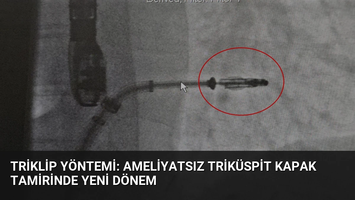 Triklip Yöntemi: Ameliyatsız Triküspit Kapak Tamirinde Yeni Dönem